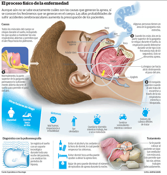 Qué causa la apnea obstructiva del sueño